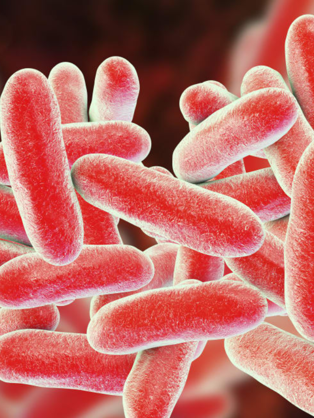 Legionnaire's disease is a severe form of pneumonia caused by inhaling Legionella bacteria.
